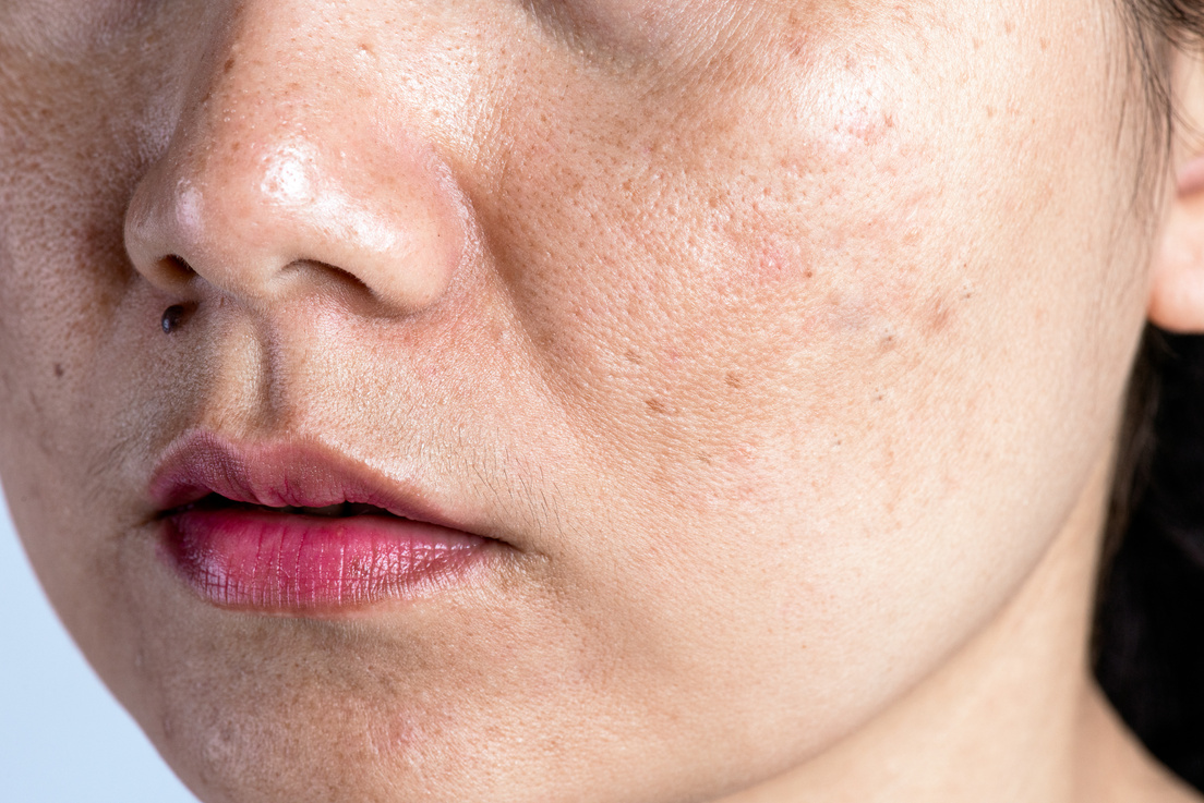 Woman with problematic skin and acne scars. Problem skincare and health concept. Wrinkles melasma Dark spots freckles dry skin and pigmentation on face asian woman.